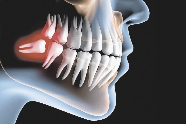 Mitos-e-verdades-sobre-o-dente-siso