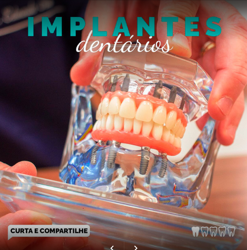 Implantes Dentista - Moema - SP