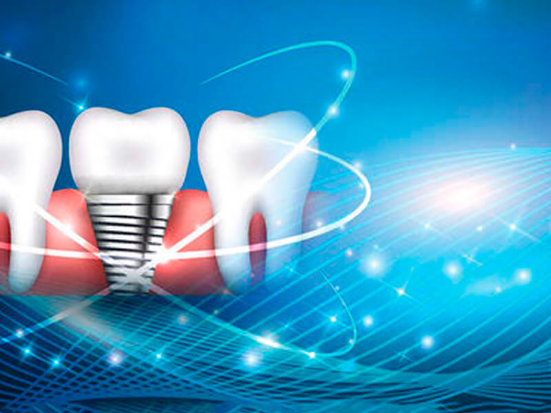 implantes-dentarios-dahdalauon-odontologia-moema-sp-ok