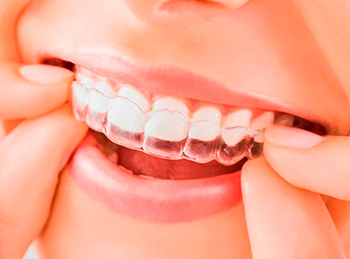 Invisalign Tratamento Estético Moema SP