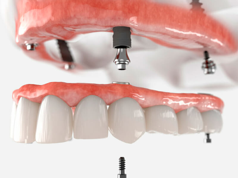 Protocolo Sobre Implantes Moema SP