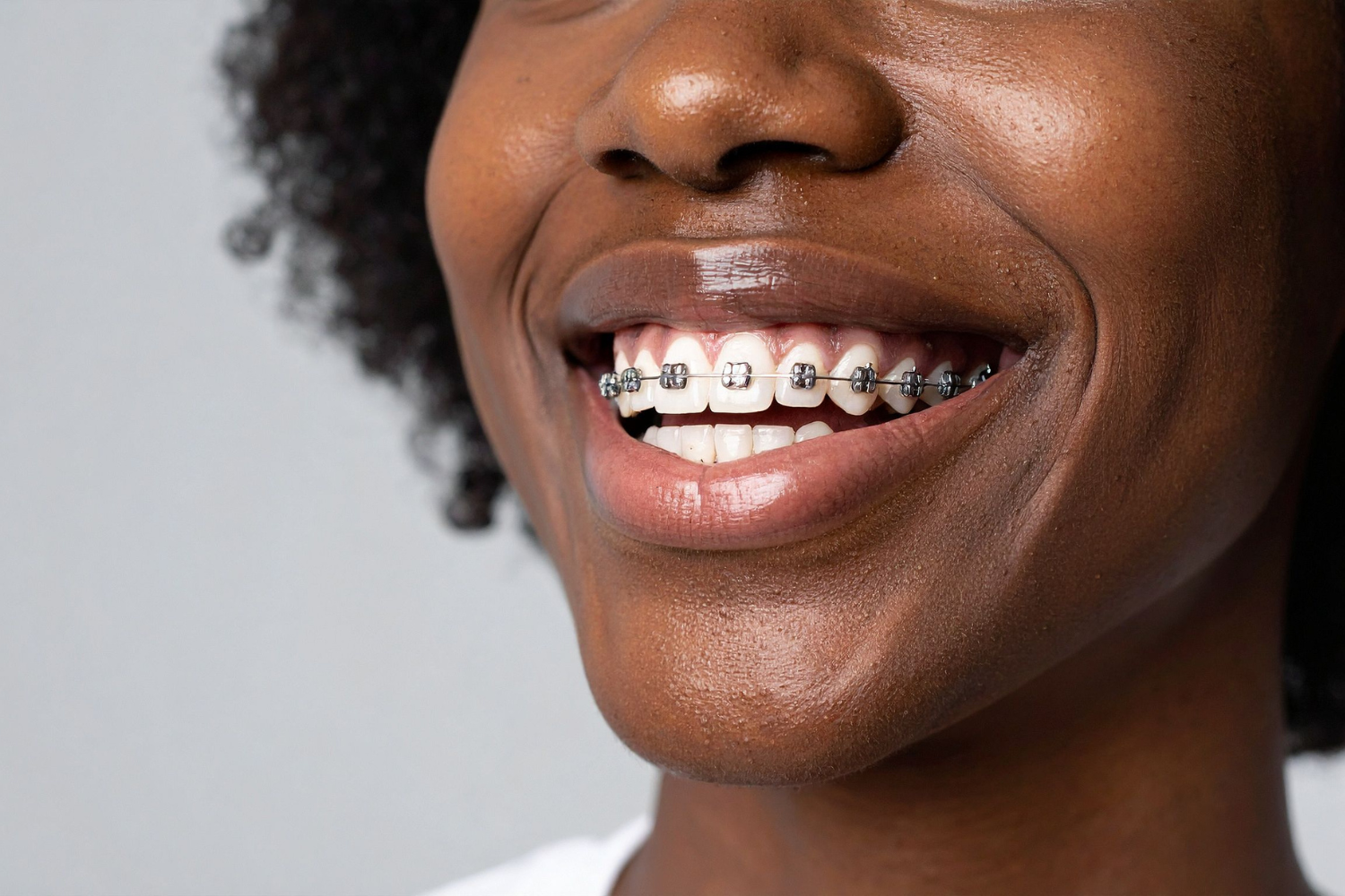 Como Cuidar do Meu Aparelho Autoligado Nas Festas de Fim De Ano