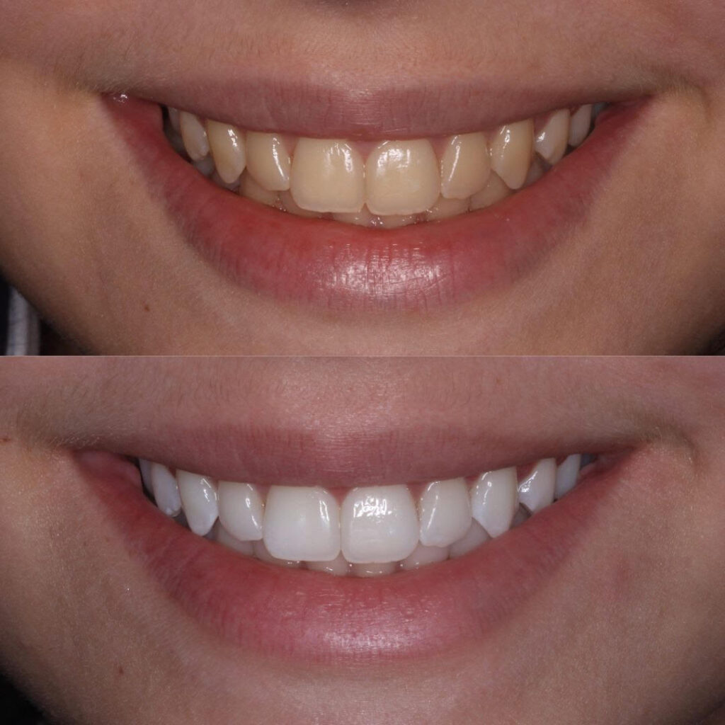 Antes e depois de paciente de clareamento dental. Estética Dental na Dahdal Aoun