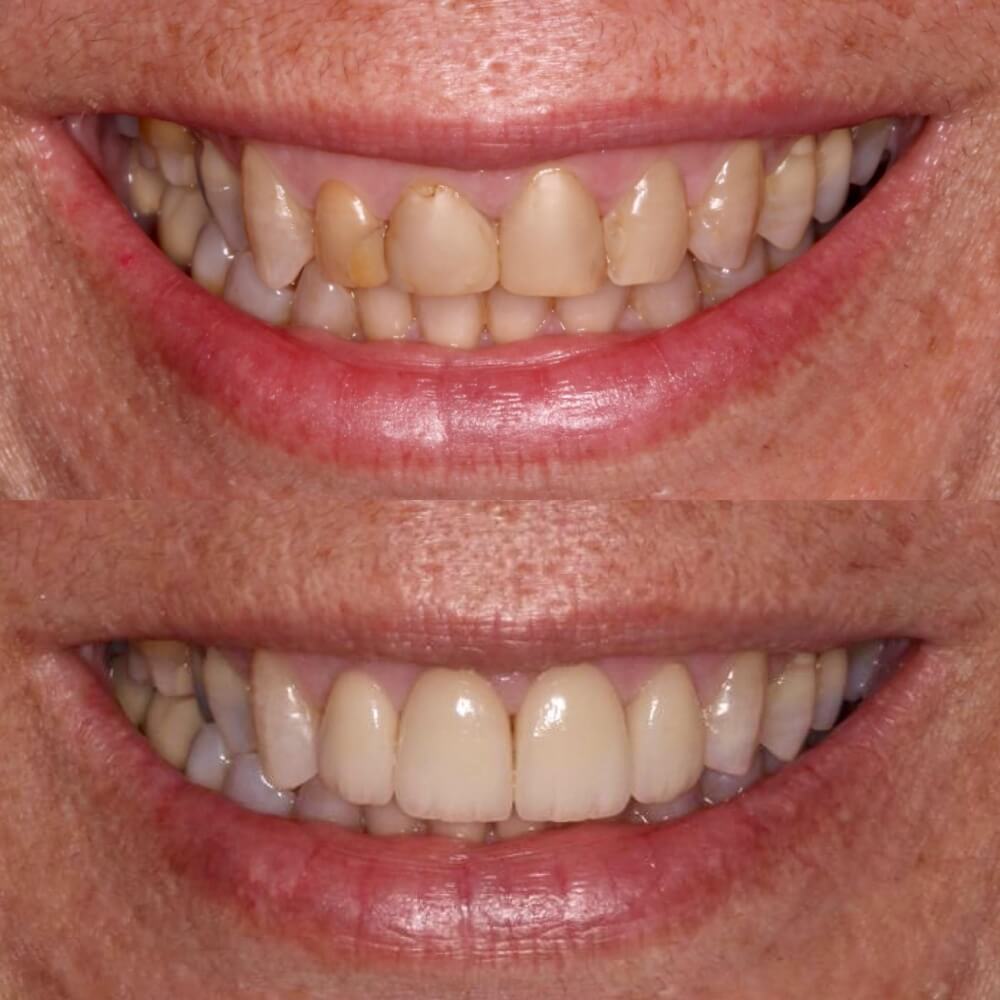 Antes e depois de paciente de lentes de contato dental e facetas em porcelana