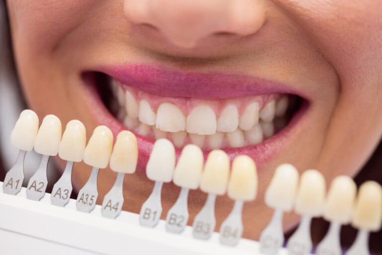Especialista compara escala de cores com dentes da paciente para aplicação de lentes de contato dental em Moema na Dahdal Aoun Odontologia.