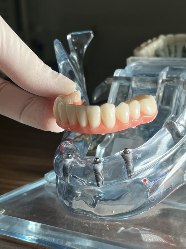 Implante Dentário e Prótese Protocolo