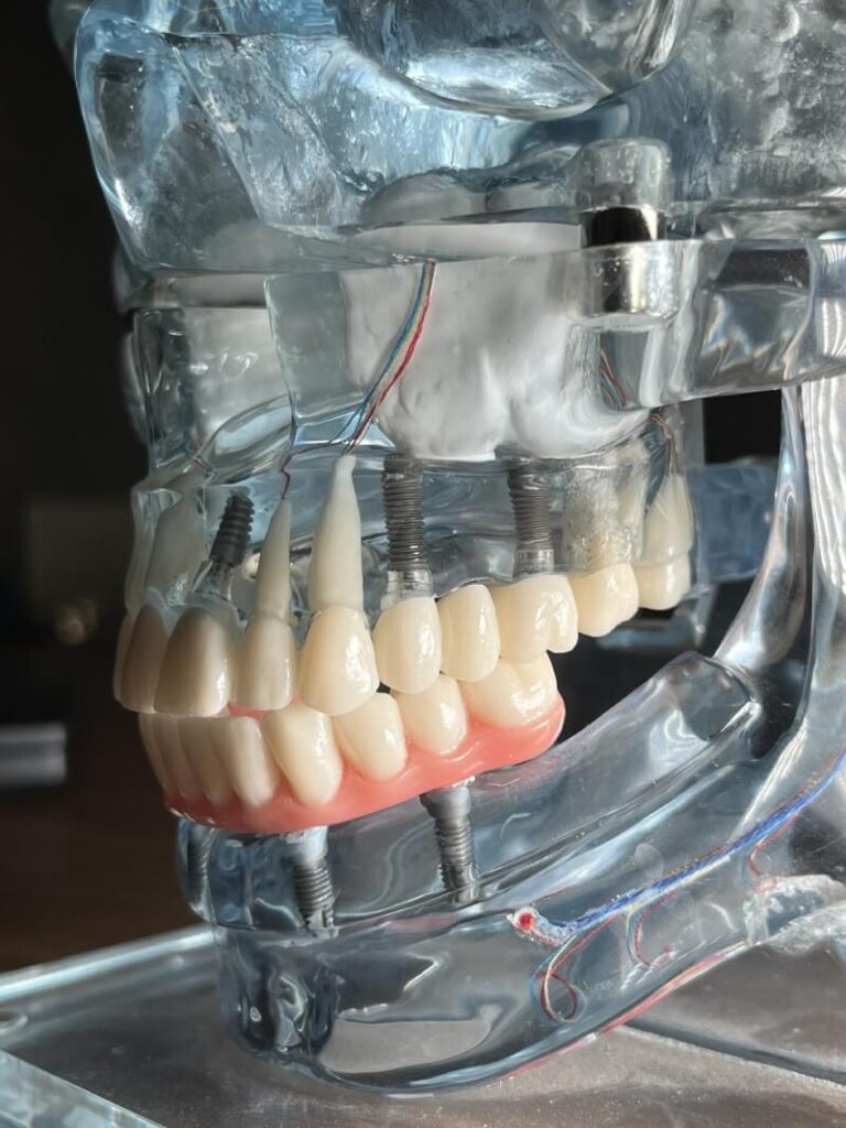 Implantes Dentários e Prótese Protocolo