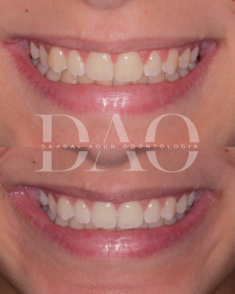 Periodontia tratamento de gengiva em moema