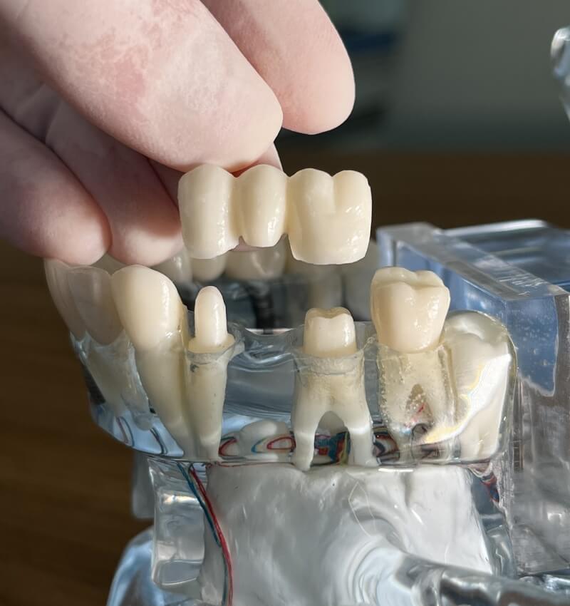 Prótese Dentária Moema Melhores Dentistas