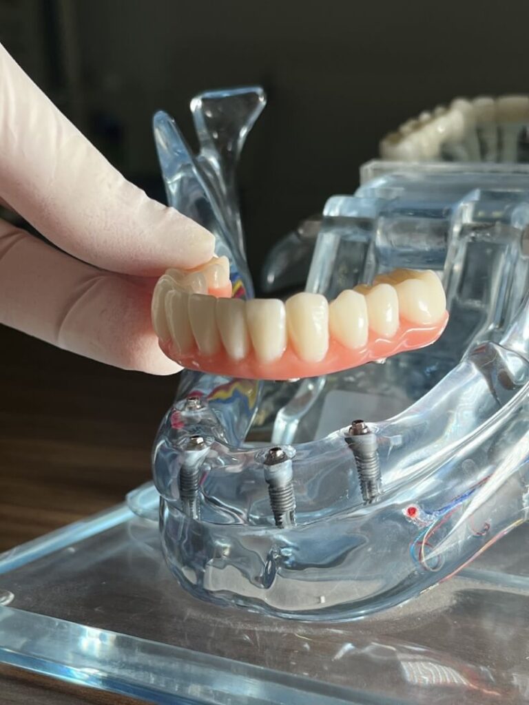 Protocolo Sobre Implantes em Moema Dentistas Especialistas